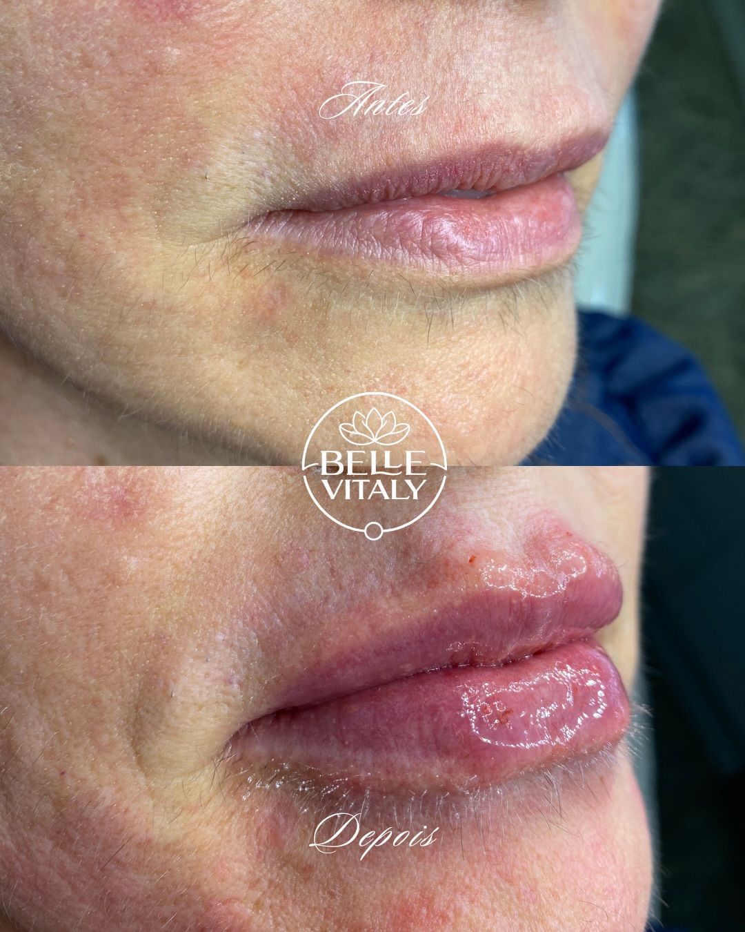 Preenchimento labial, antes (em cima) e depois (embaixo): lábios com mais contorno e volume, vista em três quartos.