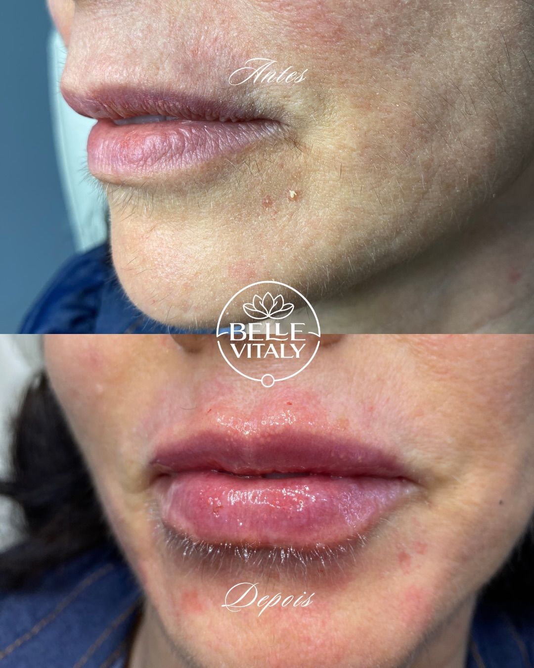 Preenchimento labial, antes (em cima) e depois (embaixo): contorno mais definido, vista lateral.