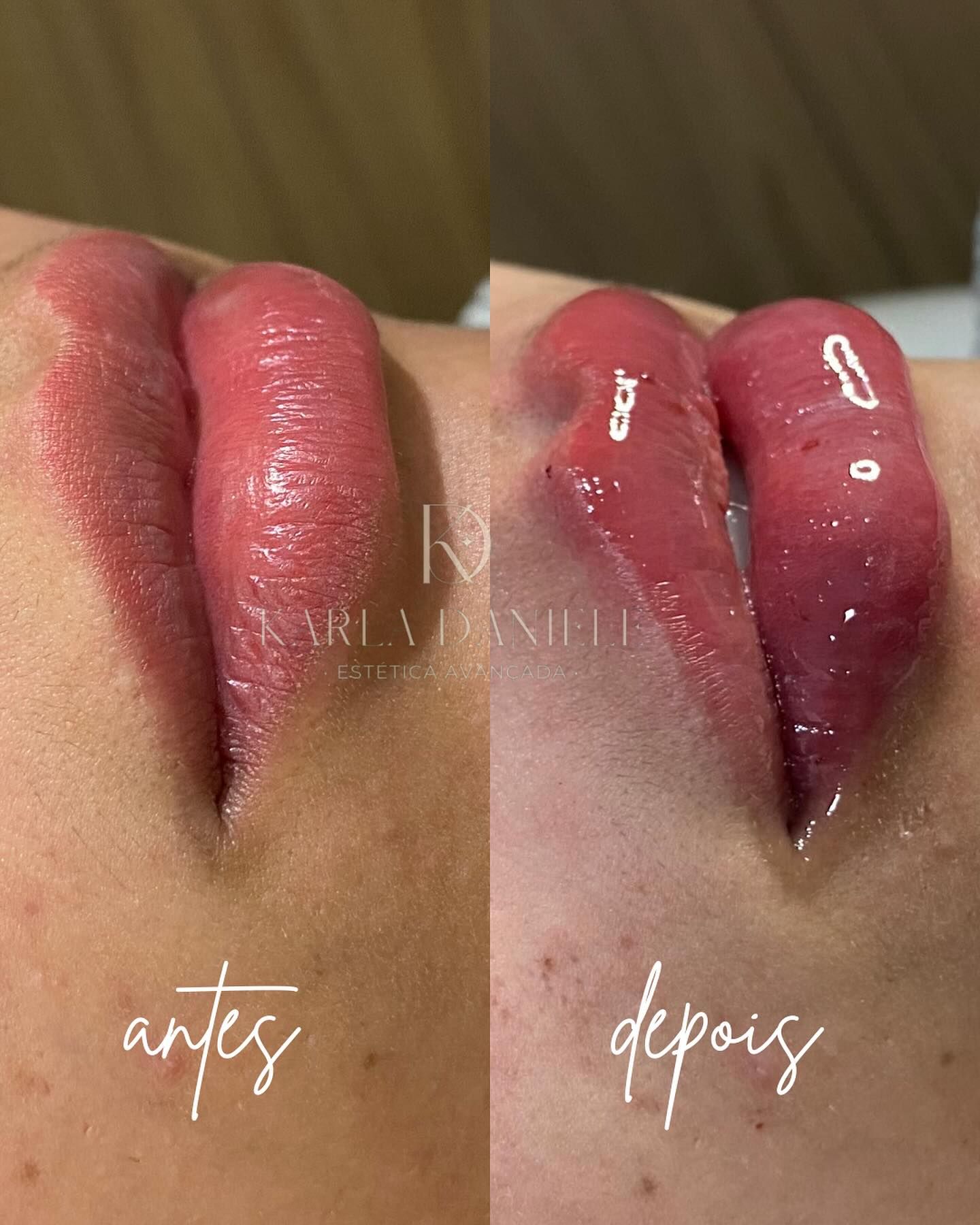 Preenchimento labial em close lateral, antes (à esquerda) e depois (à direita), com mais volume e definição.